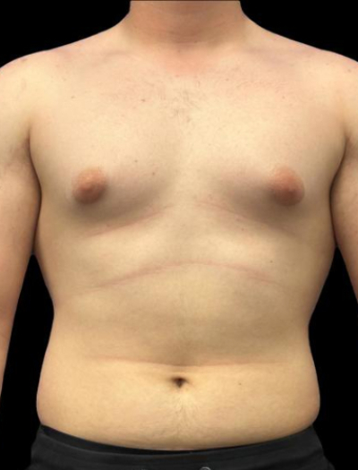 Before — Gynecomastia Reduction, Patient #45563