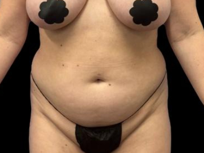 Before — S.M.A.R.T. Tummy Tuck, Patient #55814
