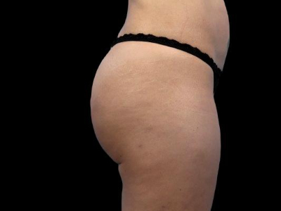 After — True Curve BBL, Patient #65632, view 2