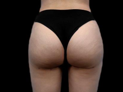 After — True Curve BBL, Patient #23477
