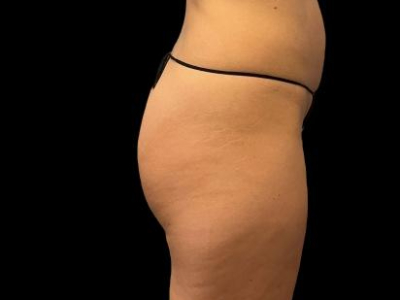 Before — True Curve BBL, Patient #65632, view 2