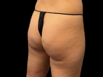 Before — True Curve BBL, Patient #65632, view 3
