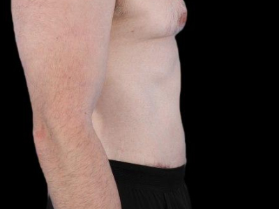After — Tummy Tuck, Patient #77187, view 4