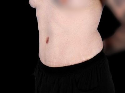 After — Tummy Tuck, Patient #77187, view 3