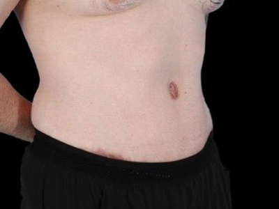 After — Tummy Tuck, Patient #77187, view 2