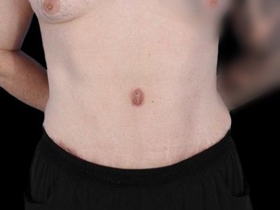 After — Tummy Tuck, Patient #77187
