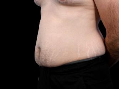 Before — Tummy Tuck, Patient #77187, view 3