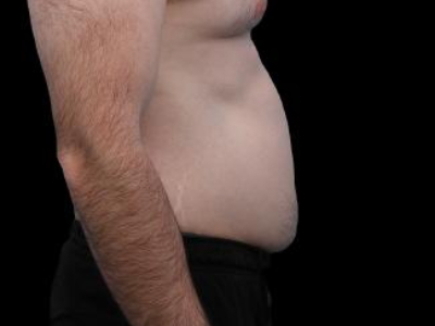Before — Tummy Tuck, Patient #77187, view 4