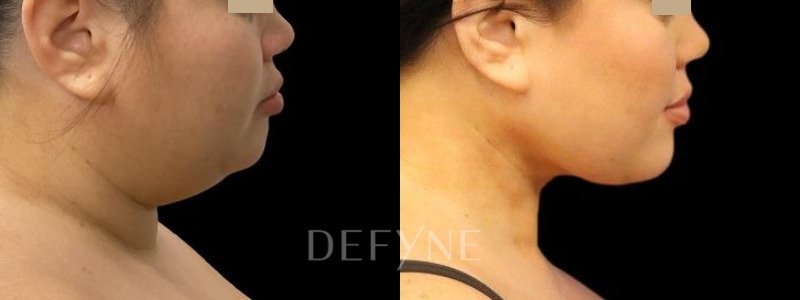before and after chin liposuction
