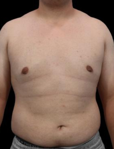 After — Gynecomastia Reduction, Patient #41431