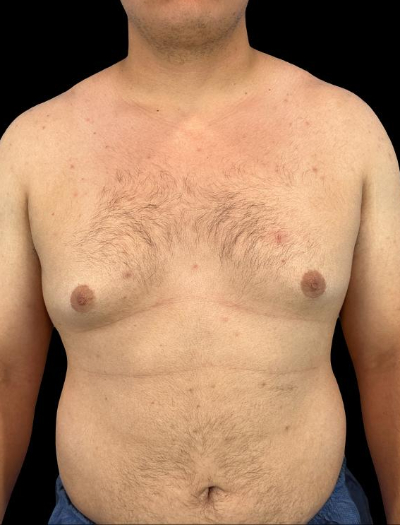 Before — Gynecomastia Reduction, Patient #41431