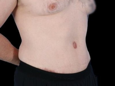 After — Tummy Tuck, Patient #94281, view 2