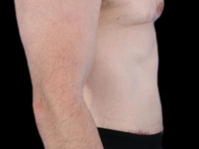 After — Tummy Tuck, Patient #94281, view 3