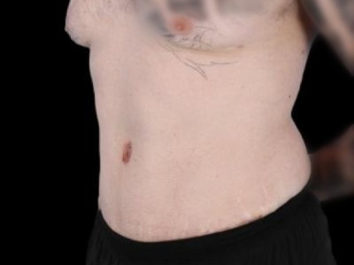 After — Tummy Tuck, Patient #94281, view 4