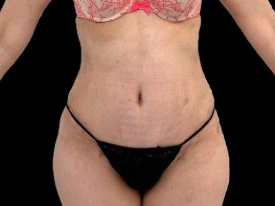 After — Tummy Tuck, Patient #53183