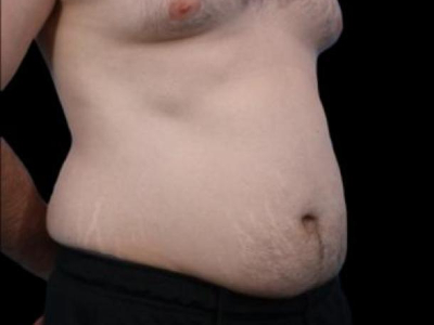 Before — Tummy Tuck, Patient #94281, view 2