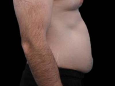 Before — Tummy Tuck, Patient #94281, view 3