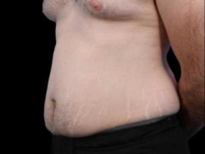 Before — Tummy Tuck, Patient #94281, view 4