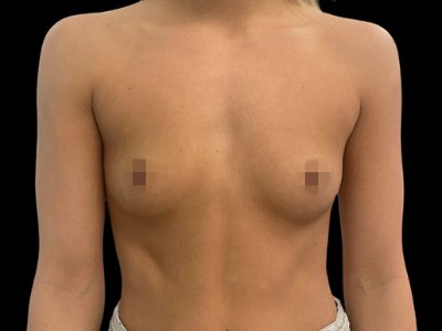 Before — Breast Augmentation with Implants, Patient #63047
