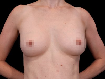 After — Breast Augmentation with Fat Grafting (True Shape), Patient #11631