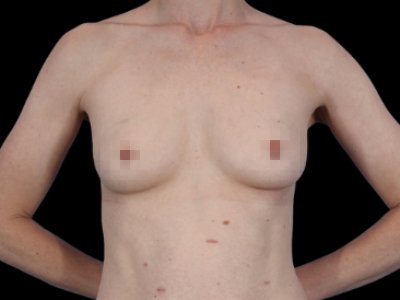 Before — Breast Augmentation with Fat Grafting (True Shape), Patient #11631