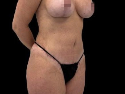 After — Tummy Tuck, Patient 68283, view 2