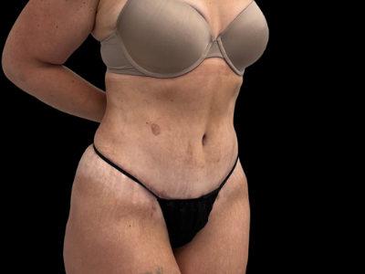 After — Tummy Tuck, Patient #38701, view 3