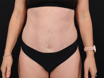 After — Tummy Tuck, Patient #8557