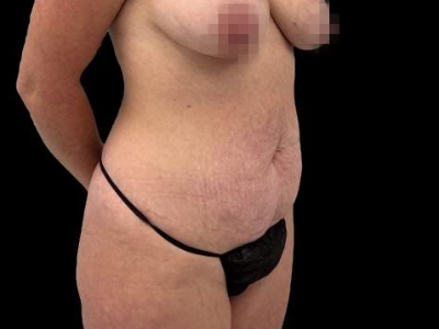 Before — Tummy Tuck, Patient 68283, view 2