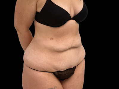 Before — Tummy Tuck, Patient #38701, view 3