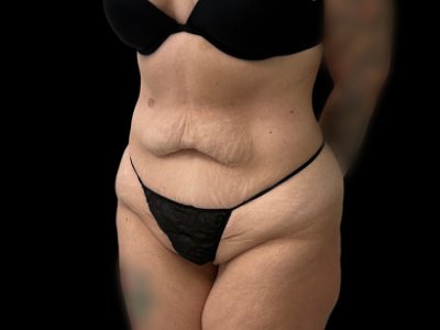 Before — Tummy Tuck, Patient #38701, view 2