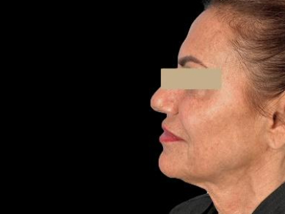 After — ReGen Dermacore, Patient #33471