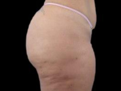 After — True Curve BBL, Patient #21035, view 2