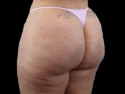 After — True Curve BBL, Patient #21035, view 3