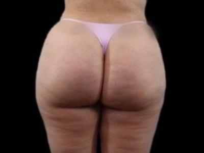 After — True Curve BBL, Patient #21035, view 4
