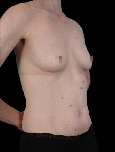 Before — 360° Refyne, Patient #82001, view 2