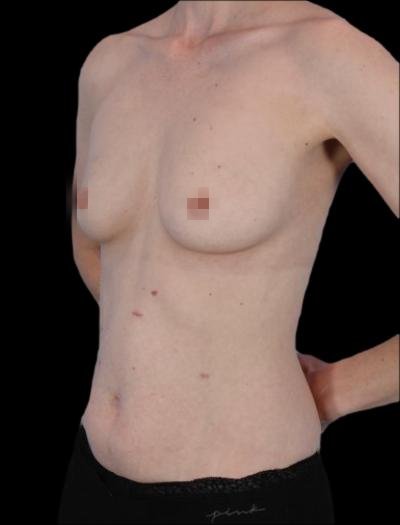 Before — 360° Refyne, Patient #82001, view 3