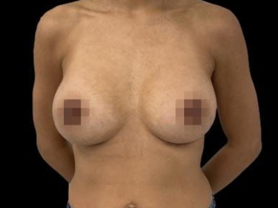 After — Breast Augmentation with Implants, Patient #104376