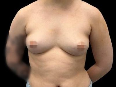 Before — Breast Augmentation with Implants, Patient #27276