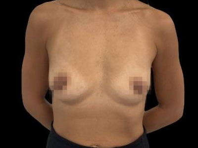 Before — Breast Augmentation with Implants, Patient #104376