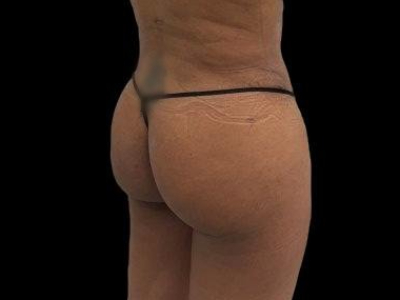 After — True Curve BBL, Patient #100855, view 2