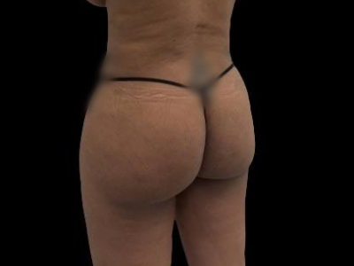 After — True Curve BBL, Patient #100855, view 3