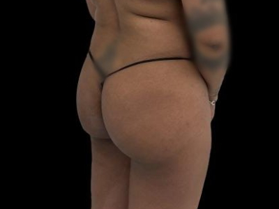 Before — True Curve BBL, Patient #100855, view 2