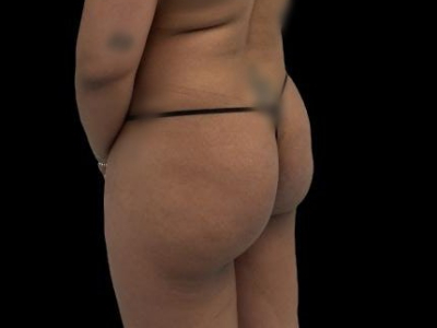 Before — True Curve BBL, Patient #100855, view 3