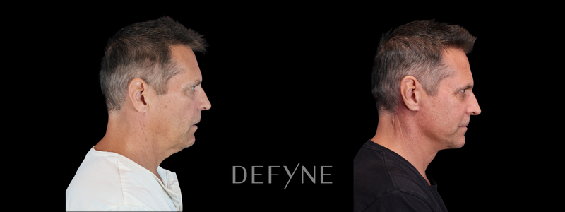 Before and after — Neck Lift, Patient #3562
