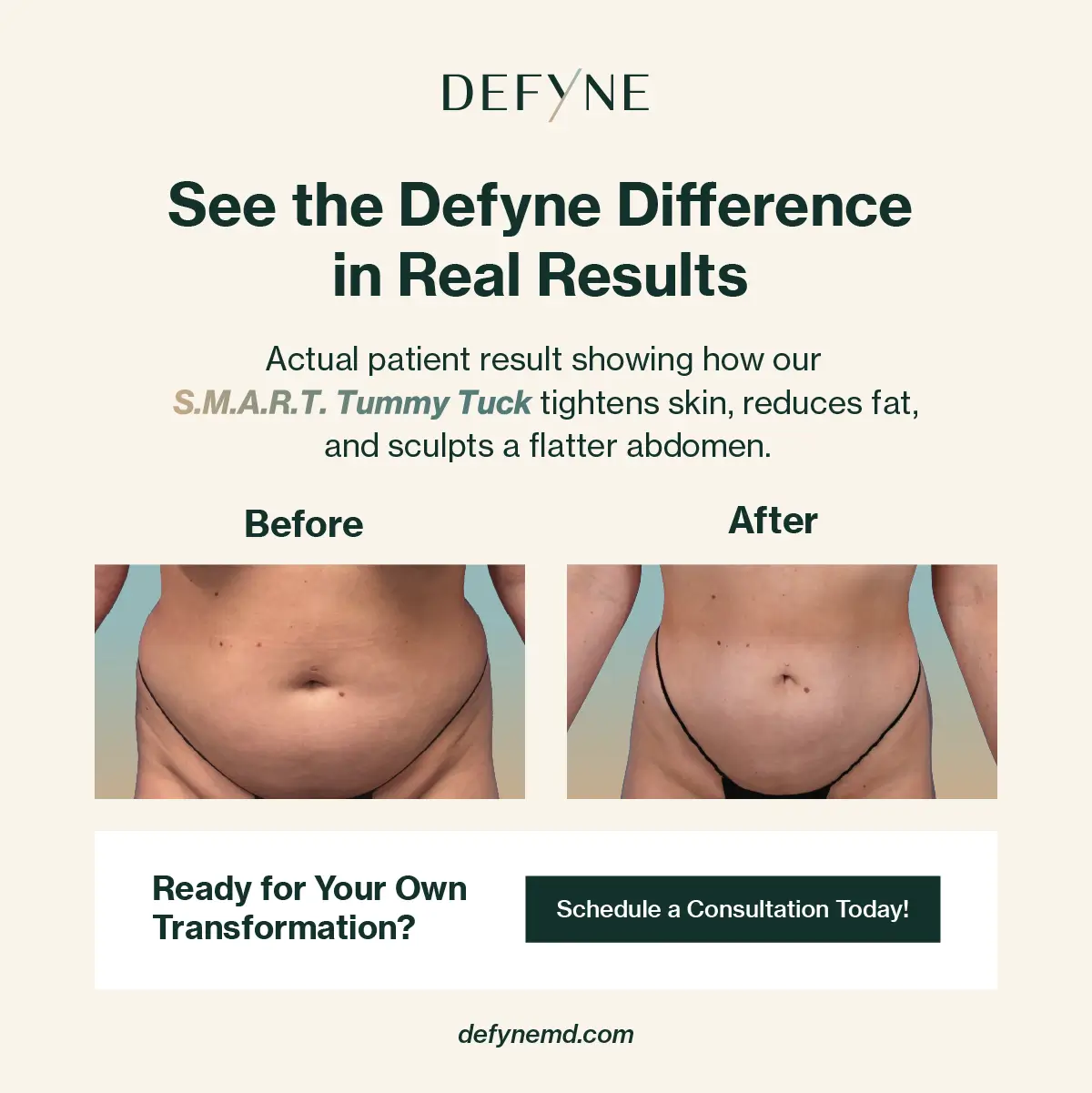 before and after S.M.A.R.T. Tummy Tuck