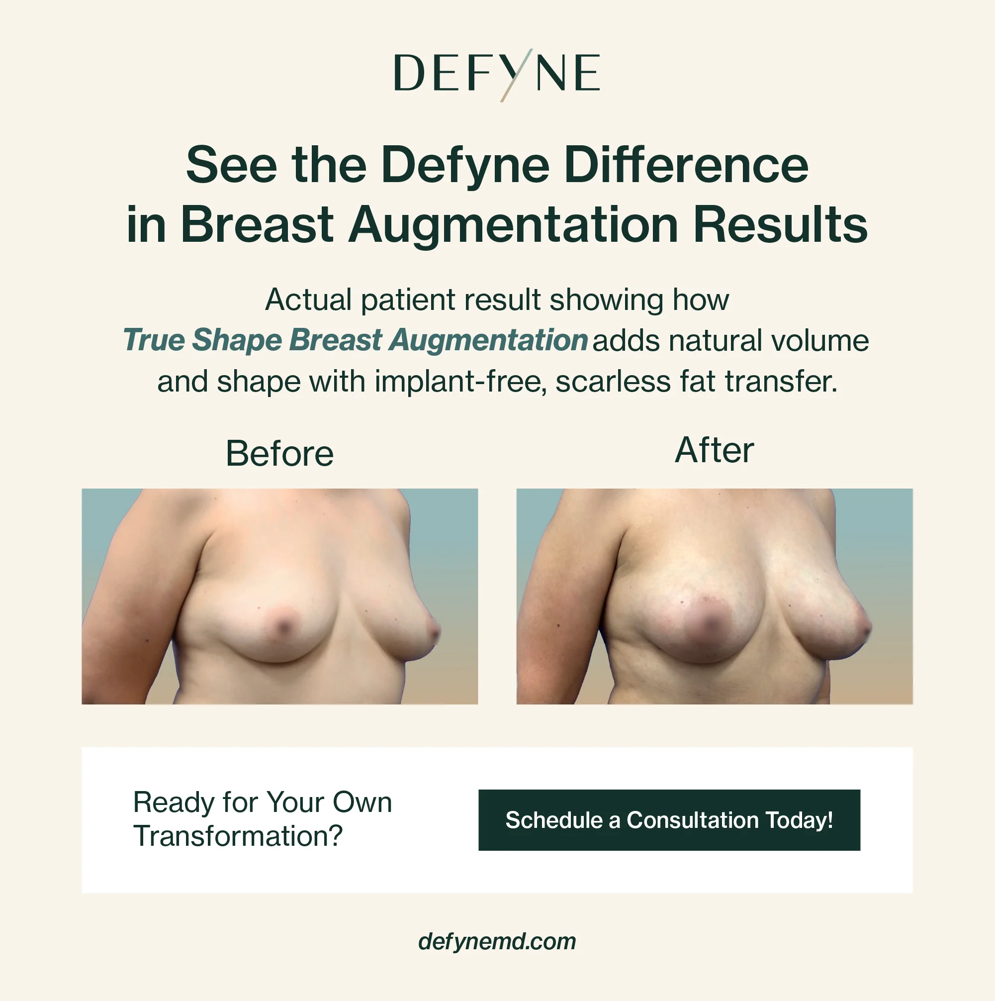 True Shape Breast Augmentation