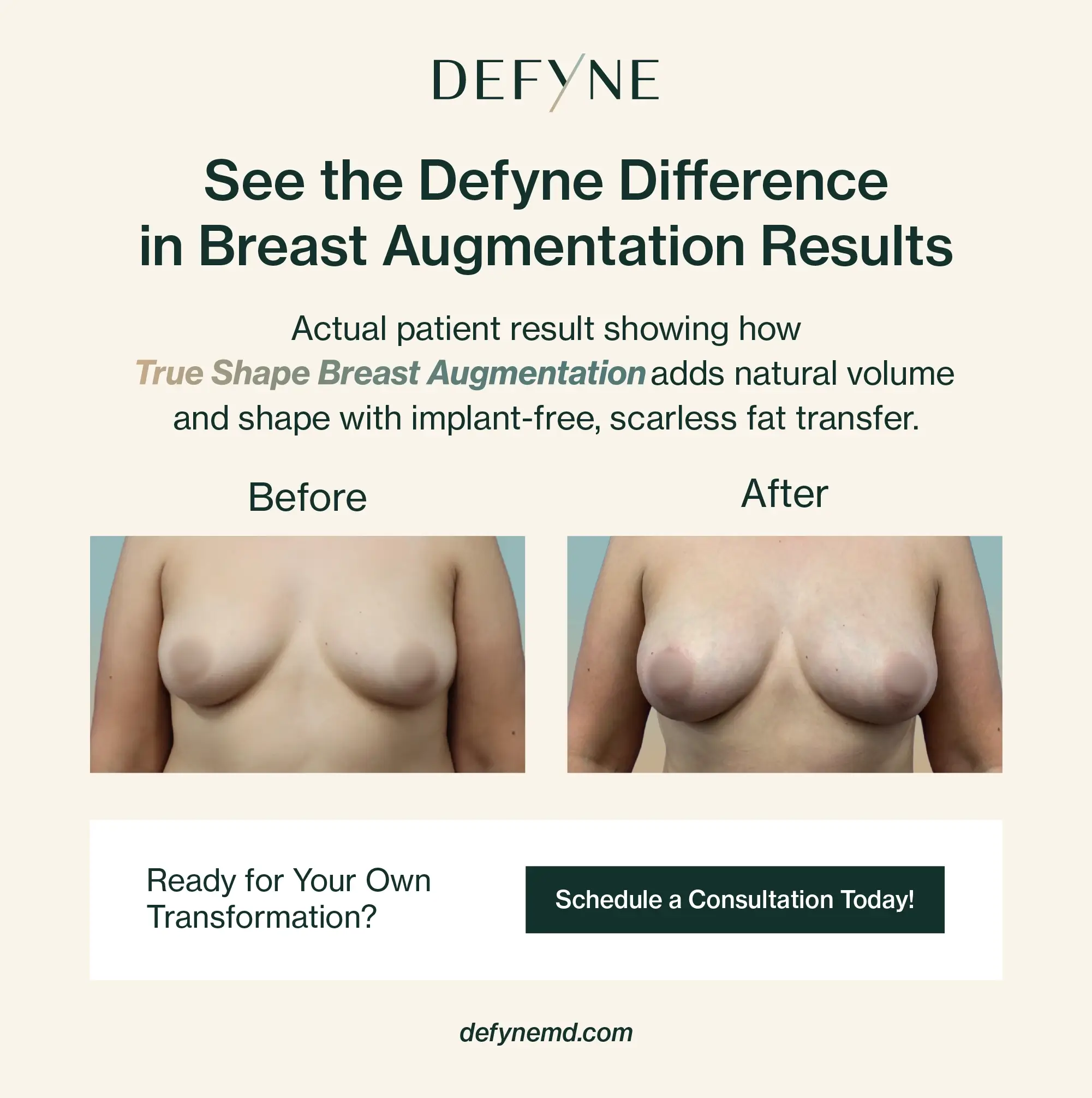 before and after true shape breast augmentation