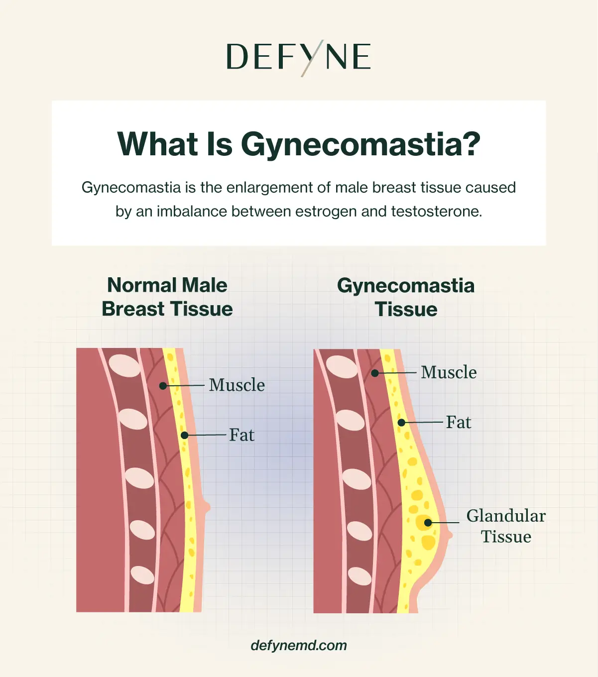 Graphic depicting gynecomastia tissue