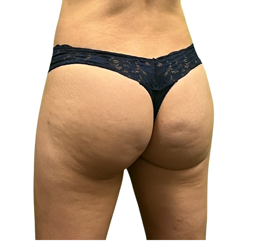 cellulite before